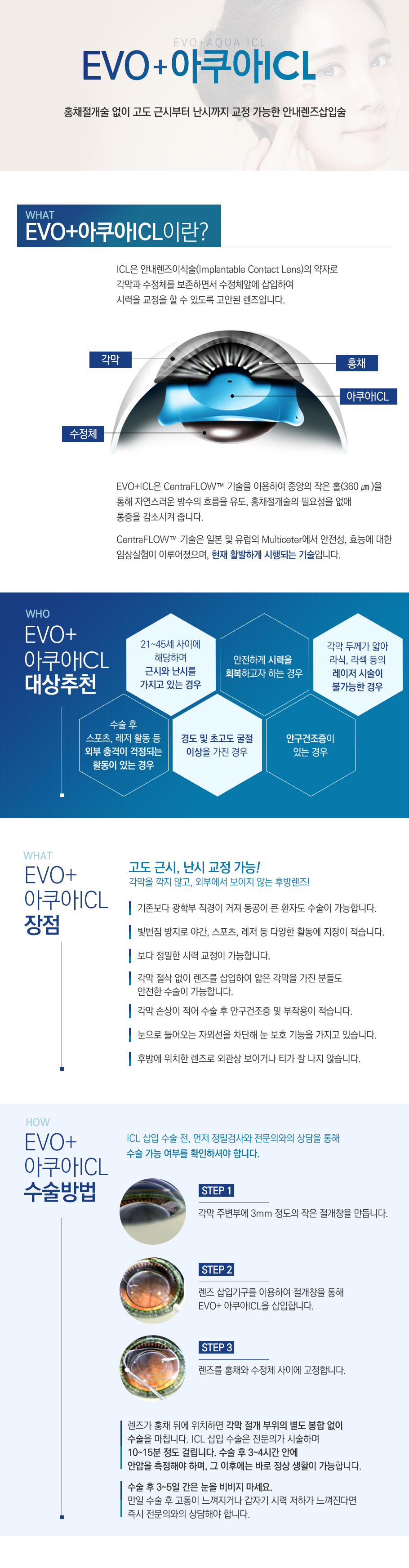 원추각막렌즈