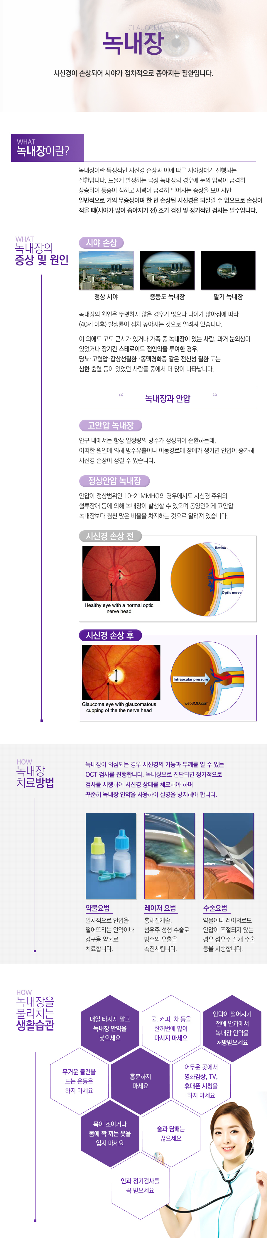 녹내장